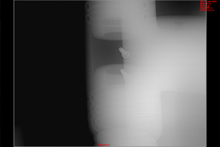 Insulating Basin - Crack Defect 05